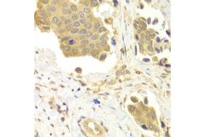 Immunohistochemistry of paraffin-embedded human mammary cancer using GABARAP antibody (ABIN6291799) at dilution of 1:100 (40x lens). (GABARAP antibody)