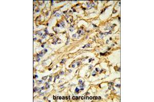 Formalin-fixed and paraffin-embedded human breast carcinoma reacted with CHMP4B Antibody (N-term), which was peroxidase-conjugated to the secondary antibody, followed by DAB staining. (CHMP4B antibody  (N-Term))