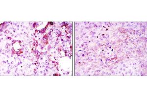 Immunohistochemical analysis of paraffin-embedded mammary cancer tissues (left) and lung cancer tissues (right) using TNFRSF11B mouse mAb with DAB staining. (Osteoprotegerin antibody)