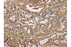 The image on the left is immunohistochemistry of paraffin-embedded Human thyroid cancer tissue using ABIN7191987(PPP2R3A Antibody) at dilution 1/30, on the right is treated with synthetic peptide. (PPP2R3A antibody)