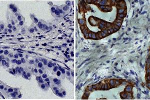 Paraffin embedded human gastric cancer tissue was stained with Mouse IgG2a-HRP isotype control followed by DAB and hematoxylin. (Cytokeratin 19 antibody  (C-Term))