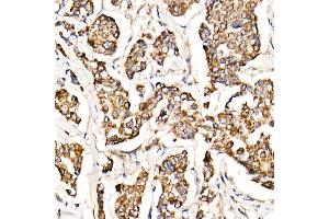 Immunohistochemistry of paraffin-embedded human breast cancer using [KO Validated] MyD88 Rabbit mAb (ABIN7268723) at dilution of 1:1000 (40x lens). (MYD88 antibody)