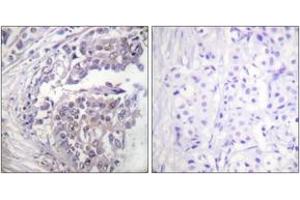 Immunohistochemistry analysis of paraffin-embedded human breast carcinoma tissue, using Histone H2B (Acetyl-Lys5) Antibody. (Histone H2B antibody  (acLys5))