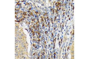 Immunohistochemistry of paraffin-embedded human esophageal cancer using V Rabbit mAb (ABIN7271305) at dilution of 1:100 (40x lens). (VAV3 antibody)