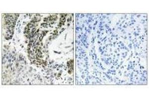 Immunohistochemistry analysis of paraffin-embedded human lung carcinoma tissue using RREB1 antibody. (RREB1 antibody)