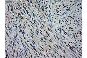 Immunohistochemical staining of paraffin-embedded Adenocarcinoma of colon tissue using anti-MAPK1mouse monoclonal antibody. (ERK2 antibody)