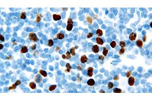 Human chronic lymphocytic leukemia: immunohistochemical staining for Geminin. (Geminin antibody  (AA 5-209))