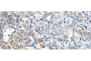 Immunohistochemistry of paraffin-embedded Human liver cancer tissue using CES2 Polyclonal Antibody at dilution of 1:55(x200) (CES2 antibody)