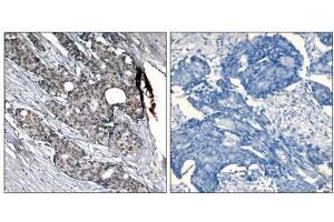 Immunohistochemical analysis of paraffin-embedded human breast carcinoma tissue using p53 (phospho- Ser6) antibody (E011092). (p53 antibody  (pSer6))