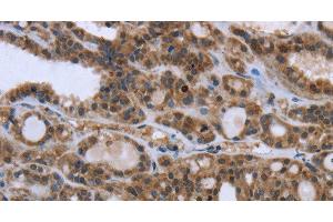 Immunohistochemistry of paraffin-embedded Human thyroid cancer using GGCX Polyclonal Antibody at dilution of 1:50 (GGCX antibody)