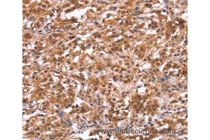 Immunohistochemistry of Human gastric cancer using AMER1 Polyclonal Antibody at dilution of 1:40 (WTX antibody)