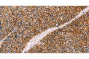 Immunohistochemistry of paraffin-embedded Human liver cancer using FGL1 Polyclonal Antibody at dilution of 1:50 (FGL1 antibody)