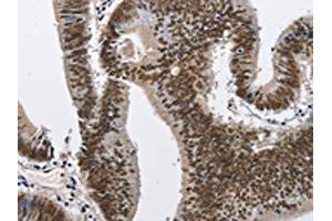 The image on the left is immunohistochemistry of paraffin-embedded Human colon cancer tissue using ABIN7128978(CMTM2 Antibody) at dilution 1/60, on the right is treated with fusion protein. (CMTM2 antibody)