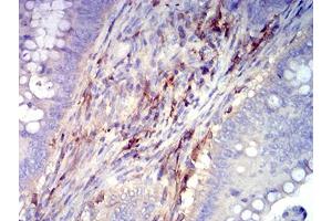 Immunohistochemical analysis of paraffin-embedded rectum cancer tissues using CD61 mouse mAb with DAB staining. (Integrin beta 3 antibody  (AA 27-179))