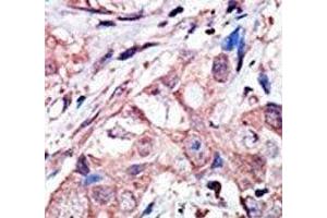 IHC analysis of FFPE human breast carcinoma tissue stained with the JNK3 antibody (MAPK10 antibody  (AA 1-30))