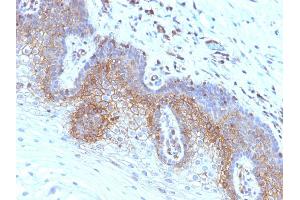 Formalin-fixed, paraffin-embedded human Cervical Carcinoma stained with Beta-2-Microglobulin Monoclonal Antibody (SPM617) (beta-2 Microglobulin antibody)