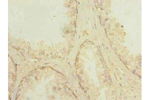 Immunohistochemistry of paraffin-embedded human prostate cancer using ABIN7166868 at dilution of 1:100 (PLPBP antibody  (AA 1-275))
