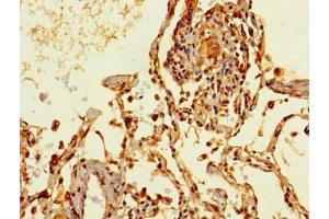 Immunohistochemistry of paraffin-embedded human lung cancer using ABIN7172158 at dilution of 1:100 (THRSP antibody  (AA 41-144))