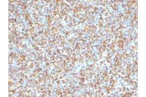 Immunohistochemistry (Formalin-fixed Paraffin-embedded Sections) (IHC (fp)) image for anti-Vimentin (VIM) antibody (ABIN3026904)