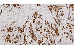 Left: Invasive ductal carcinoma (high expressor): intense nuclear staining in nearly 100 % of tumor cells. (Estrogen Receptor alpha antibody)