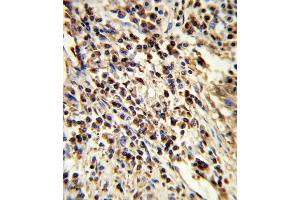 Formalin-fixed and paraffin-embedded human lung carcinoma reacted with PS Antibody (Center), which was peroxidase-conjugated to the secondary antibody, followed by DAB staining. (PSMA7 antibody  (AA 100-126))