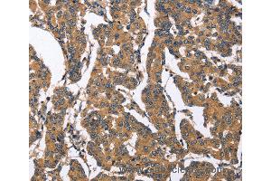 Immunohistochemistry of Human gastric cancer using BNIP2 Polyclonal Antibody at dilution of 1:50 (BNIP2 antibody)