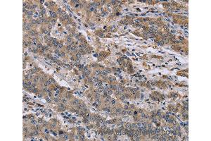 Immunohistochemistry of Human colon cancer using GSN Polyclonal Antibody at dilution of 1:40 (Gelsolin antibody)