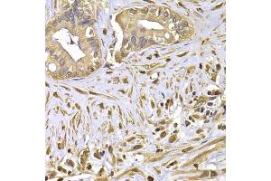 Immunohistochemistry of paraffin-embedded human liver cancer using FSCN1 antibody (ABIN6292926) at dilution of 1:100 (40x lens). (Fascin antibody)