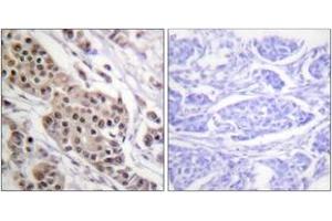 Immunohistochemistry analysis of paraffin-embedded human breast carcinoma, using p53 (Phospho-Ser392) Antibody. (p53 antibody  (pSer392))