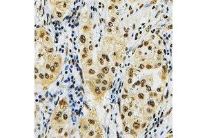 Immunohistochemical analysis of ID4 staining in human lung cancer formalin fixed paraffin embedded tissue section. (ID4 antibody  (N-Term))