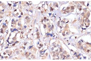 Immunohistochemistry of paraffin-embedded Human breast cancer using STK4 Polyclonal Antibody at dilution of 1:100 (40x lens). (STK4 antibody)