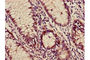 Immunohistochemistry of paraffin-embedded human colon cancer using ABIN7144378 at dilution of 1:100 (AP3M2 antibody  (AA 1-273))