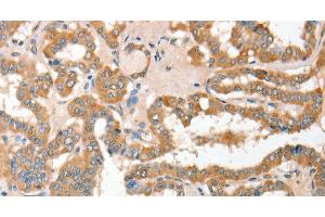 Immunohistochemistry of paraffin-embedded Human thyroid cancer using CD156c Polyclonal Antibody at dilution of 1:30 (ADAM10 antibody)