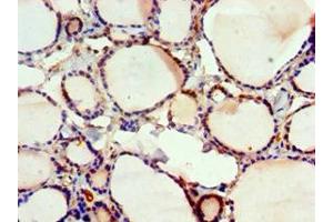 Immunohistochemistry of paraffin-embedded human thyroid tissue using ABIN7152570 at dilution of 1:100 (FUBP3 antibody  (AA 65-260))