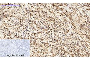 Immunohistochemical analysis of paraffin-embedded human uterus cancer tissue. (Calnexin antibody)