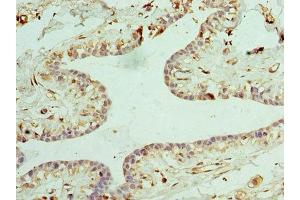 Immunohistochemistry of paraffin-embedded human breast cancer using ABIN7147858 at dilution of 1:100 (CLTA antibody  (AA 1-218))