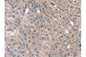 The image on the left is immunohistochemistry of paraffin-embedded Human breast cancer tissue using ABIN7192632(SPON1 Antibody) at dilution 1/25, on the right is treated with synthetic peptide. (SPON1 antibody)