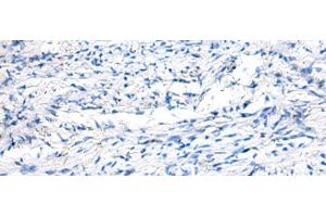 Immunohistochemistry of paraffin-embedded Human ovarian cancer tissue using FGF11 Polyclonal Antibody at dilution of 1:50(x200) (FGF11 antibody)