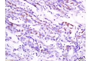 Formalin-fixed and paraffin embedded human stomach carcinoma labeled withAnti-Folate Receptor 4 Polyclonal Antibody, Unconjugated  at 1:200 followed by conjugation to the secondary antibody and DAB staining. (Folate Receptor 4 antibody)