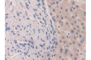 Detection of FGF19 in Human Liver cancer Tissue using Polyclonal Antibody to Fibroblast Growth Factor 19 (FGF19) (FGF19 antibody  (AA 4-216))