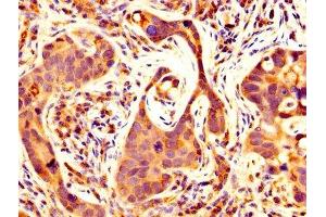 IHC image of ABIN7159063 diluted at 1:500 and staining in paraffin-embedded human pancreatic cancer performed on a Leica BondTM system. (MMP14 antibody  (AA 112-582))