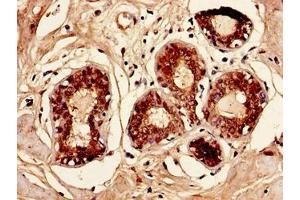 Immunohistochemistry of paraffin-embedded human breast cancer using ABIN7145972 at dilution of 1:100 (CCL2 antibody  (AA 24-99))