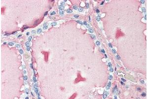 Human Thyroid (formalin-fixed, paraffin-embedded) stained with TG antibody ABIN396965 at 10 ug/ml followed by biotinylated anti-mouse IgG secondary antibody ABIN481714, alkaline phosphatase-streptavidin and chromogen. (Thyroglobulin antibody)