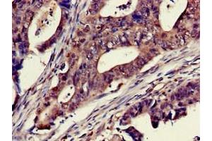 Immunohistochemistry of paraffin-embedded human colon cancer using ABIN7150733 at dilution of 1:100 (Mps1 antibody  (AA 370-492))