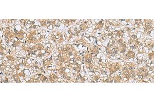 Immunohistochemistry of paraffin-embedded Human liver cancer tissue using LFNG Polyclonal Antibody at dilution of 1:60(x200) (LFNG antibody)
