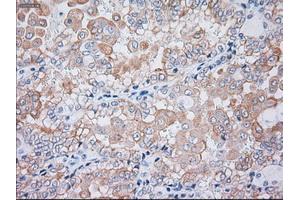 Immunohistochemical staining of paraffin-embedded liver tissue using anti-KRT19mouse monoclonal antibody. (Cytokeratin 19 antibody  (AA 240-390))