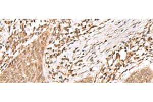 Immunohistochemistry of paraffin-embedded Human esophagus cancer tissue using KDM2A Polyclonal Antibody at dilution of 1:55(x200) (KDM2A antibody)