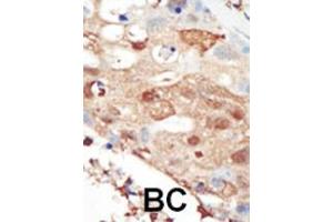 Formalin-fixed and paraffin-embedded human cancer tissue reacted with the primary antibody, which was peroxidase-conjugated to the secondary antibody, followed by AEC staining. (PIK3R2 antibody  (C-Term))