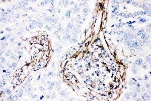 Anti-  Caveolin-1 picoband antibody, IHC(P): Human Lung Cancer Tissue (Caveolin-1 antibody  (AA 4-178))