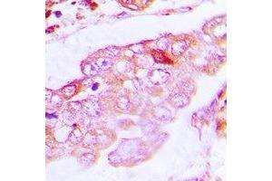 Immunohistochemical analysis of Alpha-tubulin 4a staining in human lung cancer formalin fixed paraffin embedded tissue section. (TUBA4A antibody)